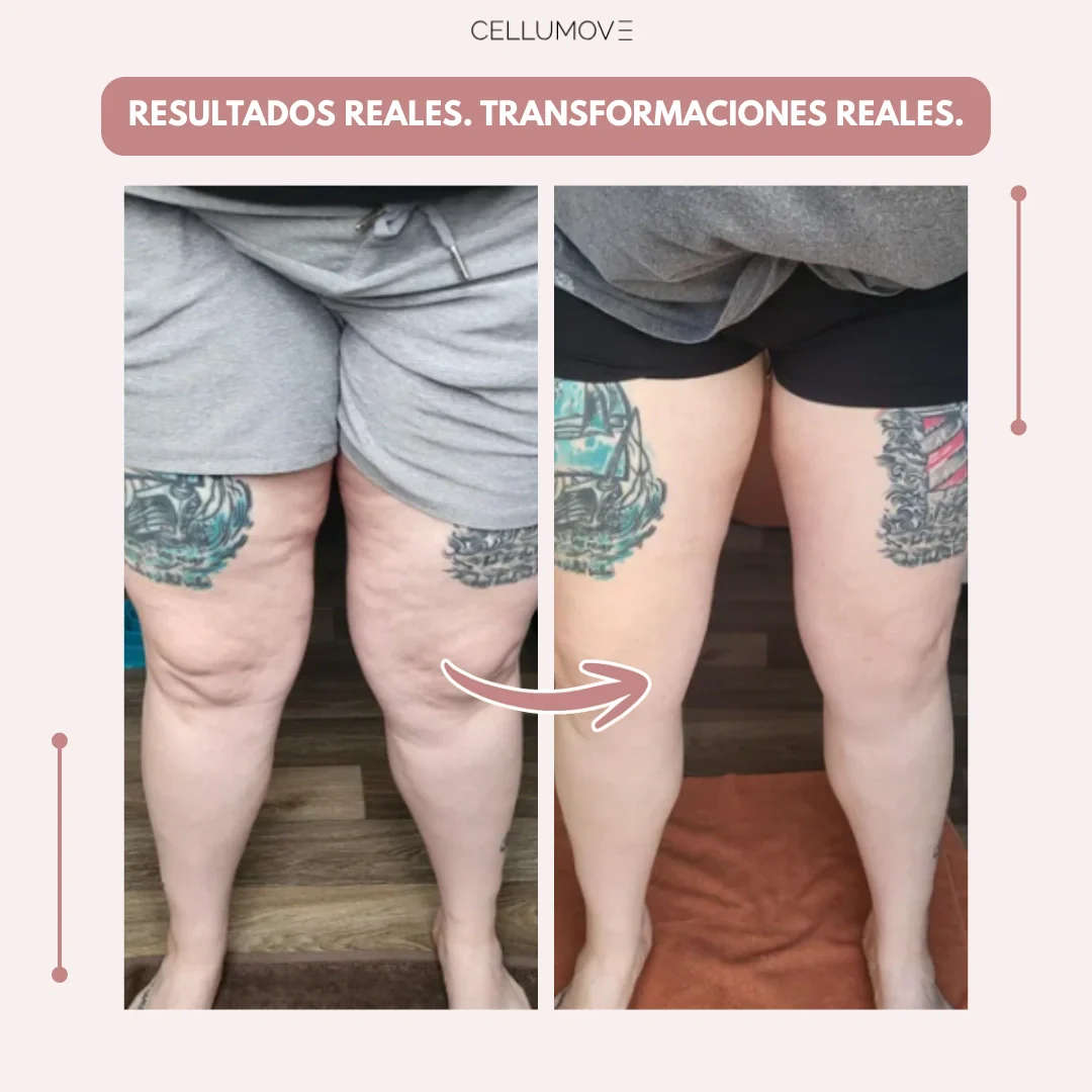 Cellumove 3D Legging – Despídete del dolor y la fatiga del lipoedema de forma natural - Image 3