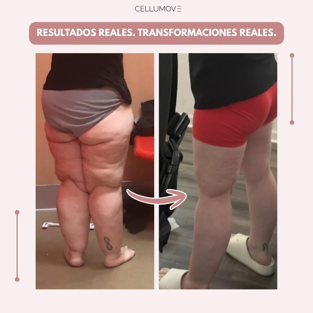 Cellumove 3D Legging – Despídete del dolor y la fatiga del lipoedema de forma natural - Image 4