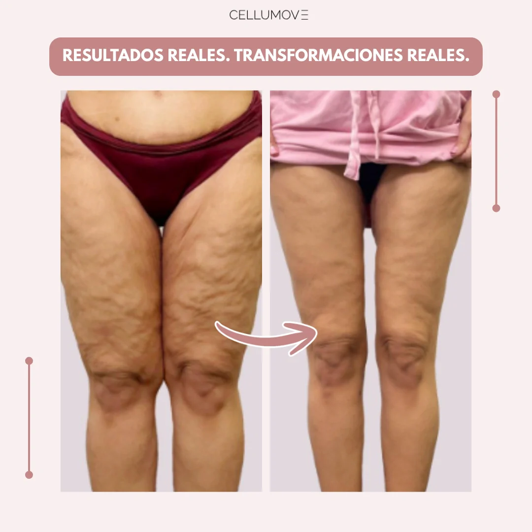 Cellumove 3D Legging – Despídete del dolor y la fatiga del lipoedema de forma natural - Image 5