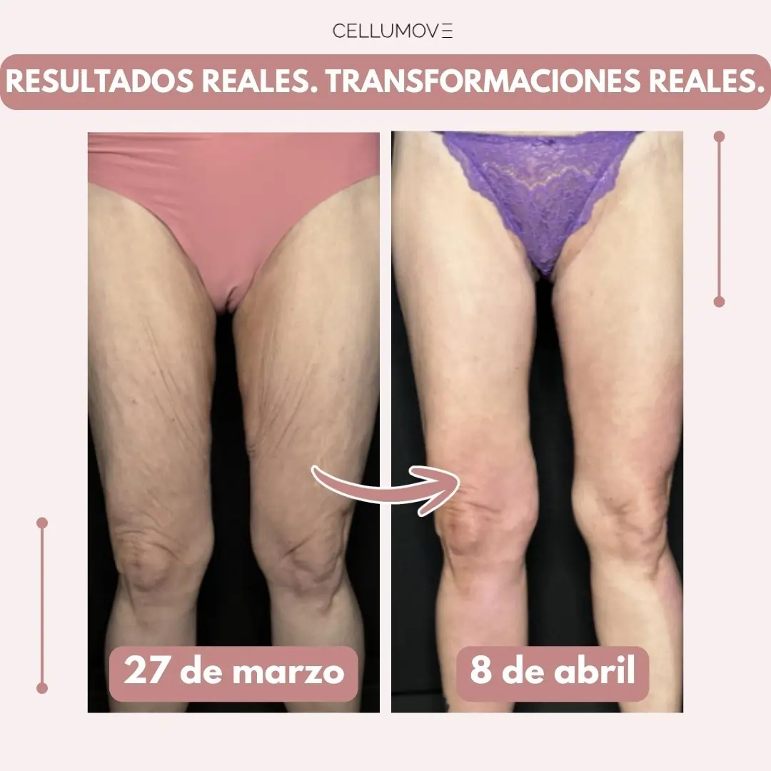 Piernas más firmes y suaves en 14 días — para mujeres cansadas de que la piel flácida las detenga (modelo mayor) - Image 4